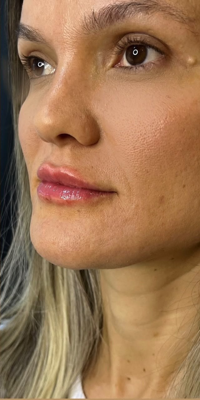Depois — Contorno labial e definição