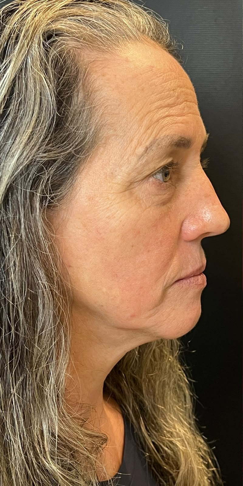 Antes — Lifting e sustentação do perfil